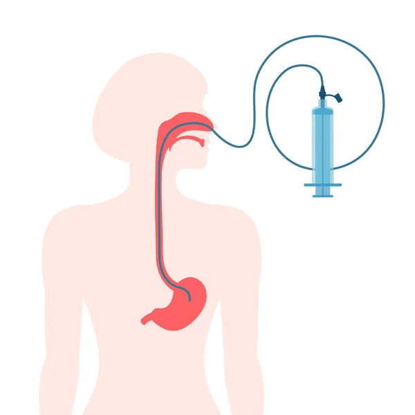 Nasogastric Tube Passed Nose Stomach Syringe Feeding Administering Medication Health — Stock Vector