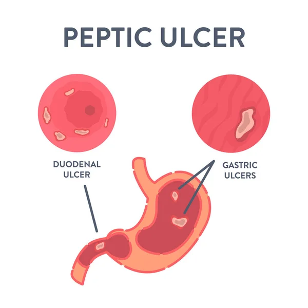 Úlcera Péptica Enfermedad Estomacal Póster Infográfico Imagen Endoscópica Estómago Con — Vector de stock