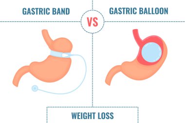 Ayarlanabilir mide bandı gastrik balona karşı. Bariatrik cerrahi kilo verme prosedürleri karşılaştırması. Mide küçültme anatomik diyagramı bilgi grafikleri. Sağlık hizmeti tıbbi konsepti. Vektör illüstrasyonu.