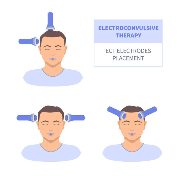 Электросудорожная терапия для тяжелой депрессии и лечения шизофрении. Электроды электрошока на пациента мужского пола. Оборудование для стимуляции мозга при основных депрессивных расстройствах. Векторная иллюстрация