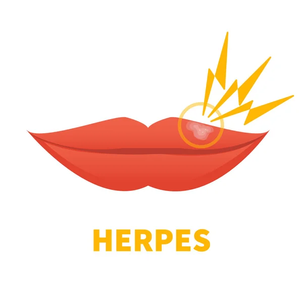 Vírus Herpes Simplex Nos Lábios Surto Dor Fria Doença Oral —  Vetores de Stock