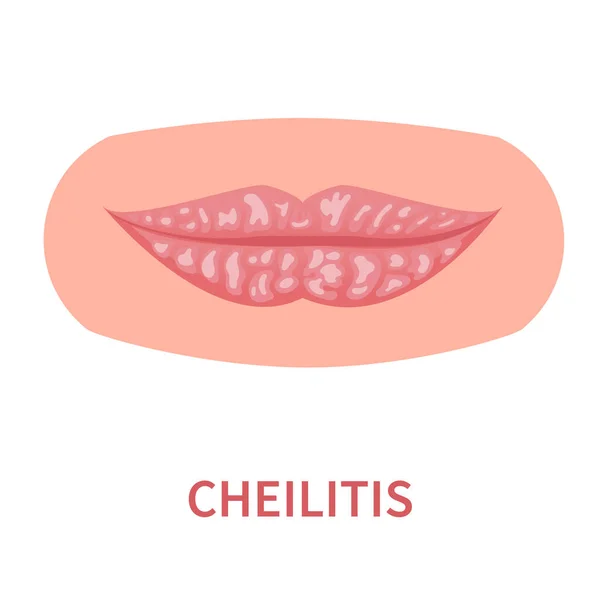 Cheilitis Oral Disease Icon Lips Inflamation Irritation Cracking Peeling Skin — Stock Vector