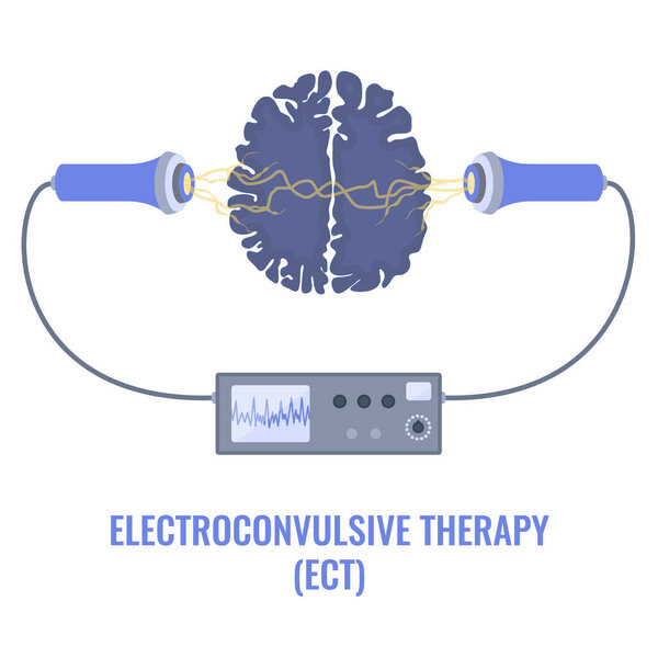 Электросудорожная терапия для тяжелой депрессии и лечения шизофрении. Размещение электродов. Оборудование для стимуляции мозга при биполярных и основных депрессивных расстройствах. Векторная иллюстрация.