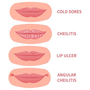 Mouth disease medical set. Cold sores and angular cheilitis with cracked corners. Lips ulcer inflamation with cracking and peeling skin. Dermatitis outbreak. Medical concept. Vector illustration. clipart