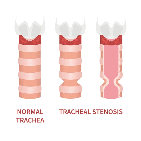 Tracheální Stenóza Ilustrace Vědomí Trachea Zužující Symbol Potíže Dýcháním Ochraptělost — Stockový vektor