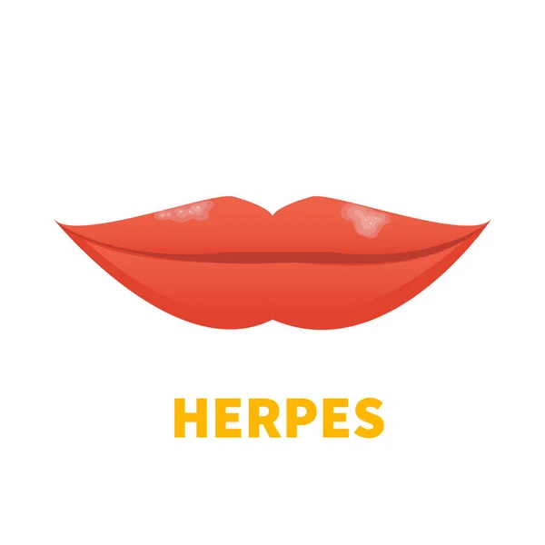 Virus Herpes Simplex Los Labios Brote Herpes Labial Enfermedad Oral — Vector de stock