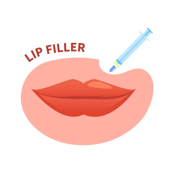 Lippenfüllungsinjektion Mit Dermalem Filler Zur Volumenverbesserung Mundkosmetische Behandlung Der Kontur — Stockvektor