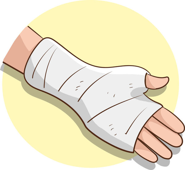 векторная иллюстрация сломанной руки со штукатуркой  