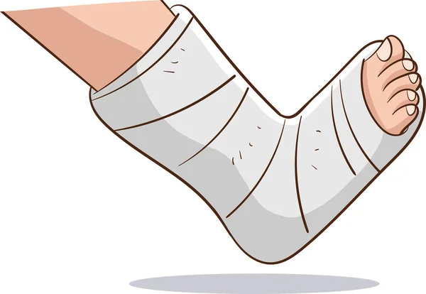 Vektorillustration Von Orthopädischem Gips Oder Glasfaserguss Gebrochenem Bein Knochenbruch — Stockvektor