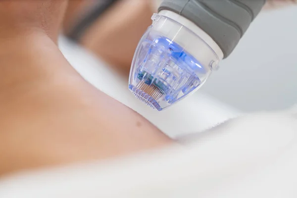 Procedimiento Elevación Microneedle Cosmetología Hardware Foto Alta Calidad Fotos de stock libres de derechos