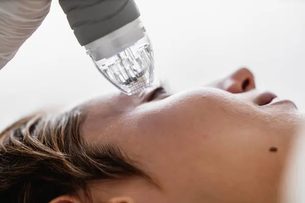 Mikroedle RF kaldırma prosedürü. Donanım kozmetolojisi. Yüksek kalite fotoğraf