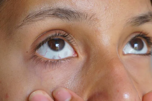 一个年轻女孩的眼睛的白斑 眼部黑色素沉着症 — 图库照片