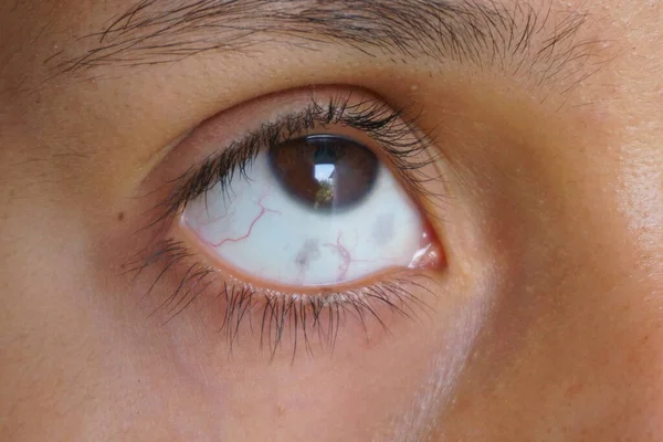 Manchas Cinzentas Parte Branca Olho Uma Jovem Melanose Ocular — Fotografia de Stock