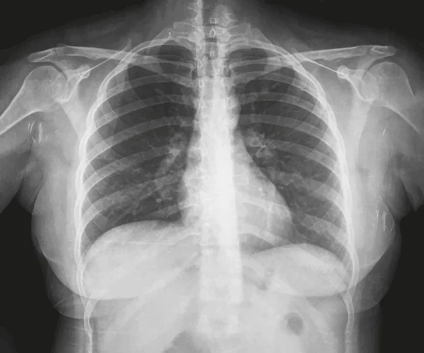 Aufrechte Brust Röntgenaufnahme Für Medizinische Forschung Und Lehre Vektorillustration — Stockvektor
