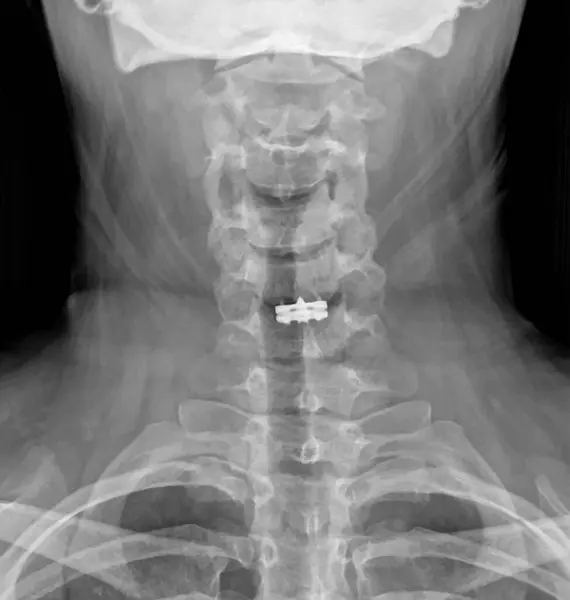 Cervical Microdiscektomy ve Servikal Disk Protezi tedavisi gören bir hastanın boyun röntgeni. Vektör illüstrasyonu. 