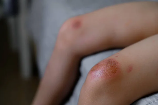 아이들이 다쳤어 피부를 할퀴고 찰과상 다리의 찰과상 상처를 이하기 방부제와 — 스톡 사진