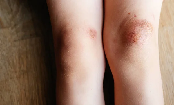 Children Injury Deep Scratches Skin Kids Knee Wounds Scratches Abrasions — Stock Photo, Image
