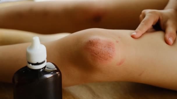 儿童受伤 孩子膝盖上的皮肤有深深的划伤 擦伤在儿童腿上 清洗伤口用的防腐剂和海绵瓶 — 图库视频影像
