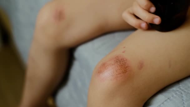 Τραυματισμός Παιδιών Βαθιές Γρατζουνιές Στο Δέρμα Του Γονάτου Των Παιδιών — Αρχείο Βίντεο