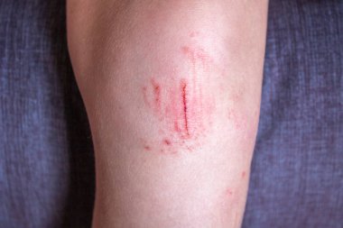 Scooterından düştükten sonra beyaz tenli, beyaz bir çocuğun dizinden yaralanmış. çocuk bakımı kavramı