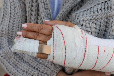 Kırığı ya da yüzük parmağındaki yarayı durdurmak için bandajlı.