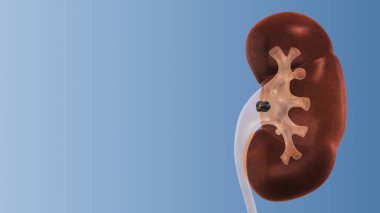 Human Kidney stones medical concept clipart