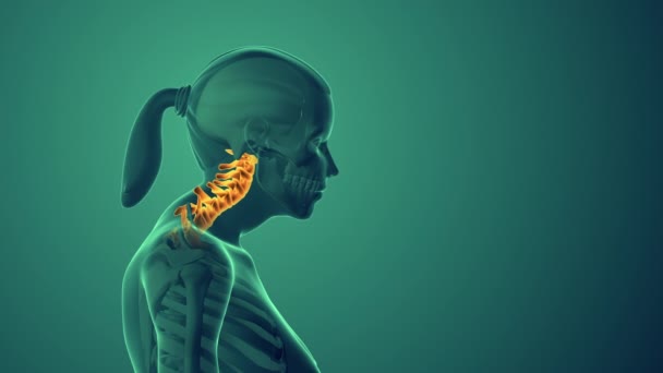 Leher Ketidaknyamanan Atau Sindrom Postural Serviks — Stok Video