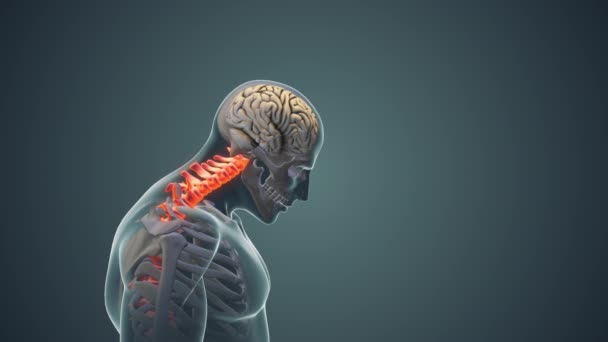 Nyeri Leher Atau Animasi Medis Sindrom Postur Serviks — Stok Video