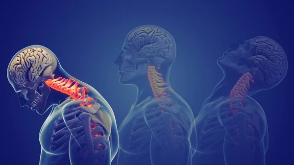 Douleur Cou Syndrome Posture Cervicale — Photo