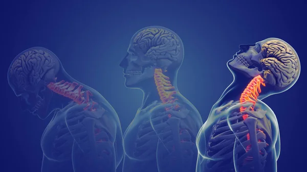 颈部疼痛或颈部姿势综合征 — 图库照片