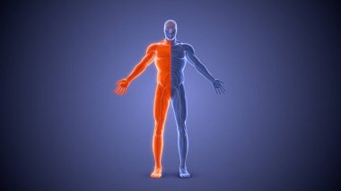 Hemipleji felci durumu Tıbbi konsept