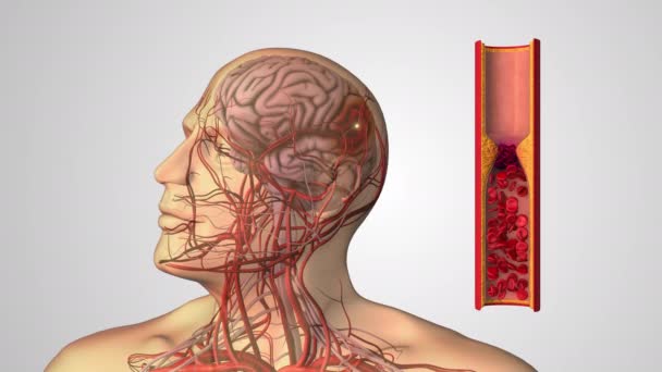 Медицинская Концепция Атеросклеротических Сердечно Сосудистых Заболеваний Инсульта — стоковое видео