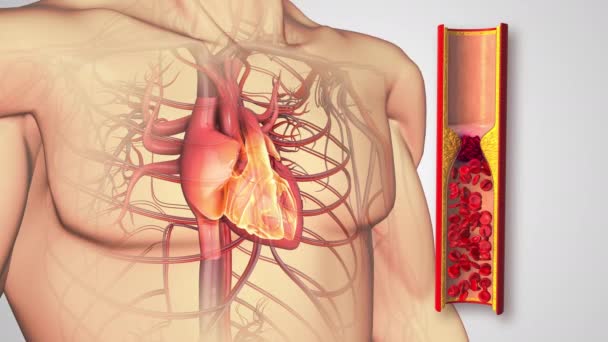 ブロックされた動脈を持つアテローム性動脈硬化症または人間の心臓 — ストック動画