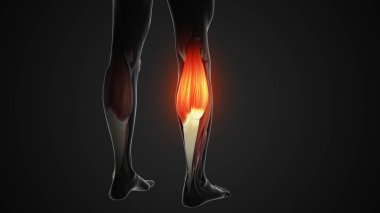 Gastrocnemius kaslarında ağrı ve yaralanma