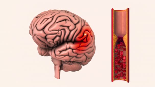Εγκεφαλοαγγειακή Νόσος Είναι Ένα Αιμορραγικό Εγκεφαλικό Επεισόδιο — Αρχείο Βίντεο