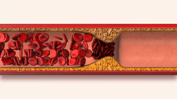 Тяжёлый атеросклероз коронарной артерии
