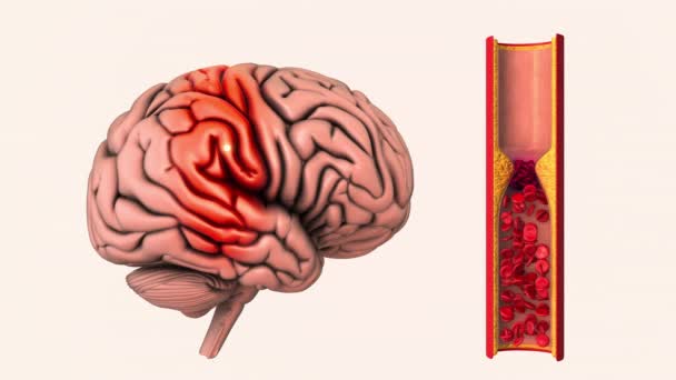 脑血管疾病是缺血性中风 — 图库视频影像