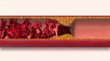 Ağır atheroskleroz koroner arter hastalığı.