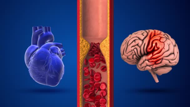 Diferença Entre Acidente Vascular Cerebral Ataque Cardíaco — Vídeo de Stock