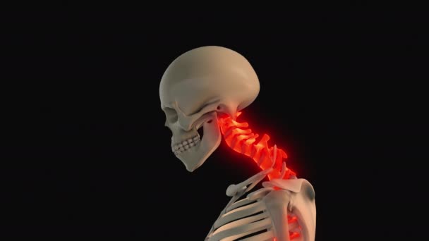 Medizinische Animation Von Haltungssyndrom Oder Nackenschmerzen — Stockvideo