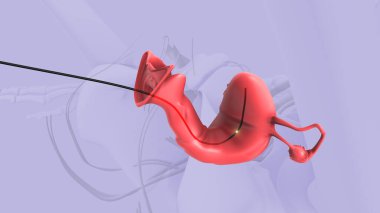 Rahim ağzı kanseri ya da intraketeryal brachytherapy için brachytherapy