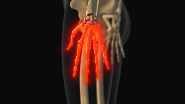 Medical animation of the metacarpals and phalanges bone pain