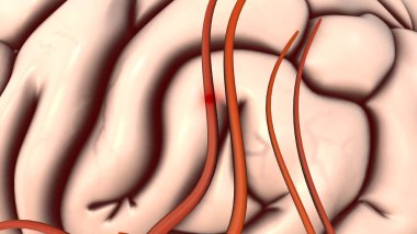 Atherosklerotik kardiyovasküler hastalık ve felç