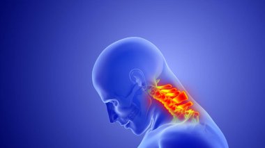 Boyun omurgasında ya da boyun yaralanmalarında omurga incinmesi.