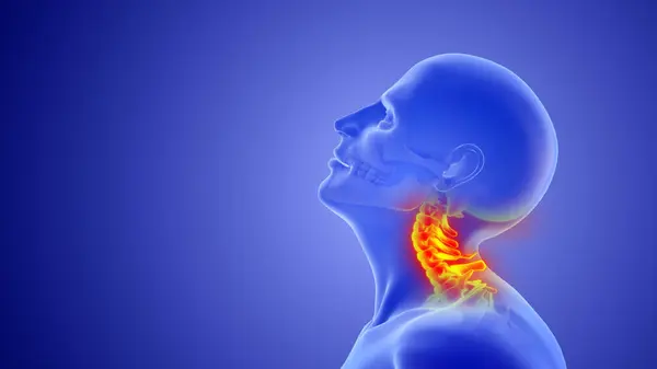 Whiplash mechanism in cervical spine or neck injuries