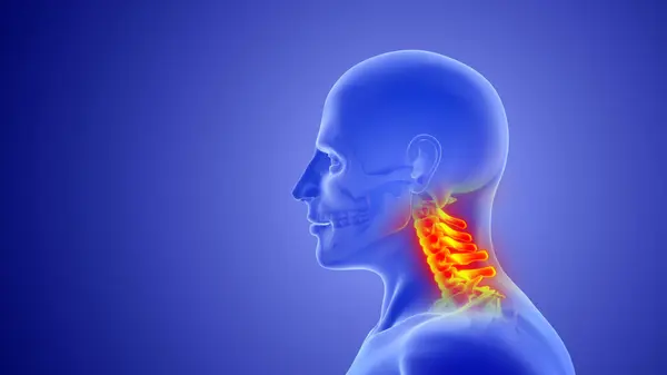 Whiplash mechanism in cervical spine or neck injuries