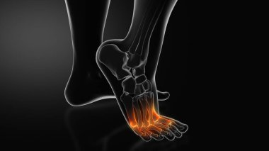 Metatarsalji ya da Ayak Ağrısı Topuğu