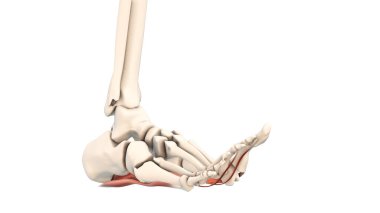 Plantar fasya bozukluğunun tıbbi animasyonu.