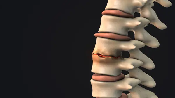 Nsan Omurgasında Osteofit Oluşumu Olan Disk Bozulması - Stok İmaj