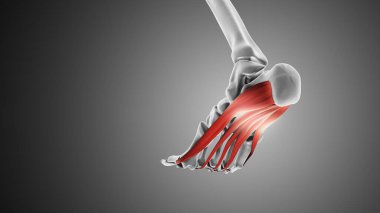 Plantar fasya fonksiyon bozukluğu Tıbbi animasyon